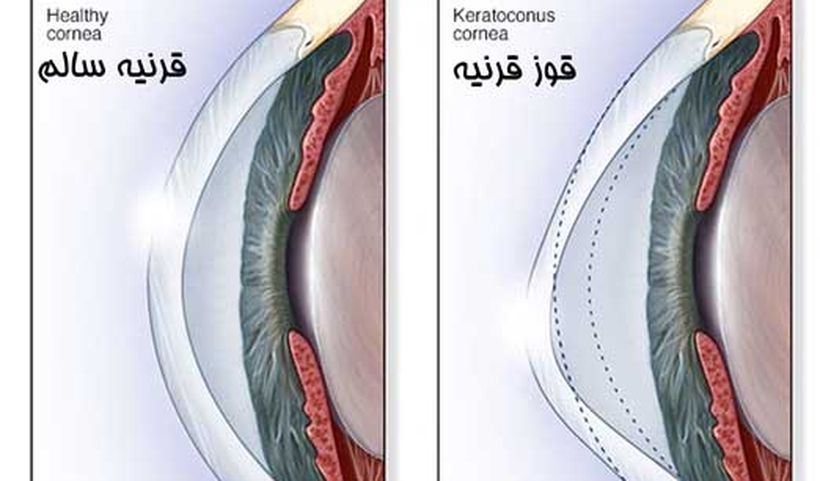 کراتوکونوس
